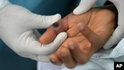 Un médico muestra una llaga en la mano de un paciente causada por la viruela símica en el hospital Arzobispo Loayza en Lima, Perú, el 16 de agosto de 2022. (Foto AP/Martín Mejía)