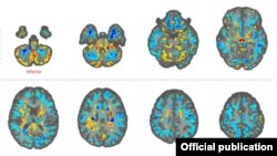 Imágenes de cerebros de algunos de los diplomáticos estadounidenses, hechas con técnicas avanzadas de resonancia magnética (Foto: Journal of the American Medical Association, JAMA).
