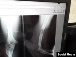 Imagen muestra la fractura sufrida por Pérez Carmenate. (Foto: Carlos Amel Oliva)