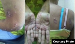 Fotos enviadas desde prisión muestran la afección en la piel de la presa política Xiomara Cruz Miranda