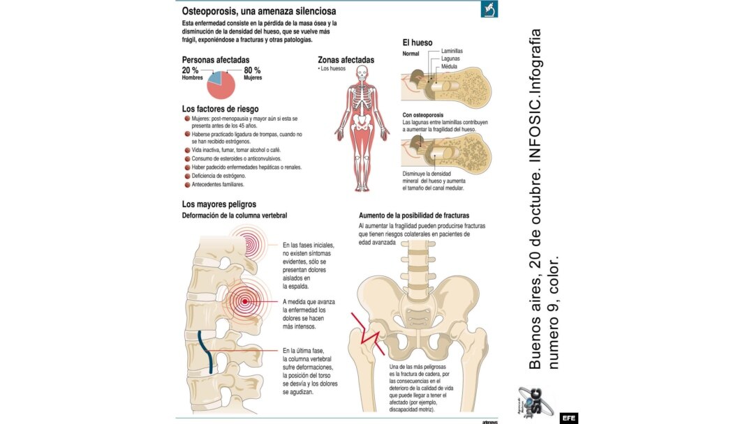 q es la osteoporosis sintomas