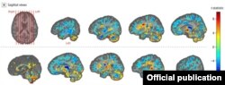 Imágenes de resonancia magnética cerebral avanzada de algunos de los participantes (Foto: Journal of the American Medical Association, JAMA).