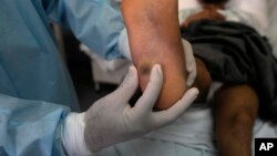 Un médico muestra una llaga en el pie de un paciente causada por viruela símica. (Foto AP/Martín Mejía)